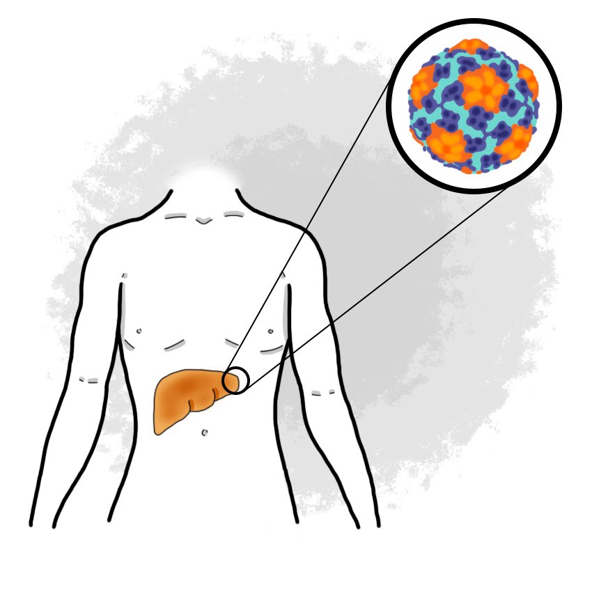 Acute hepatitis due to hepatitis A virus