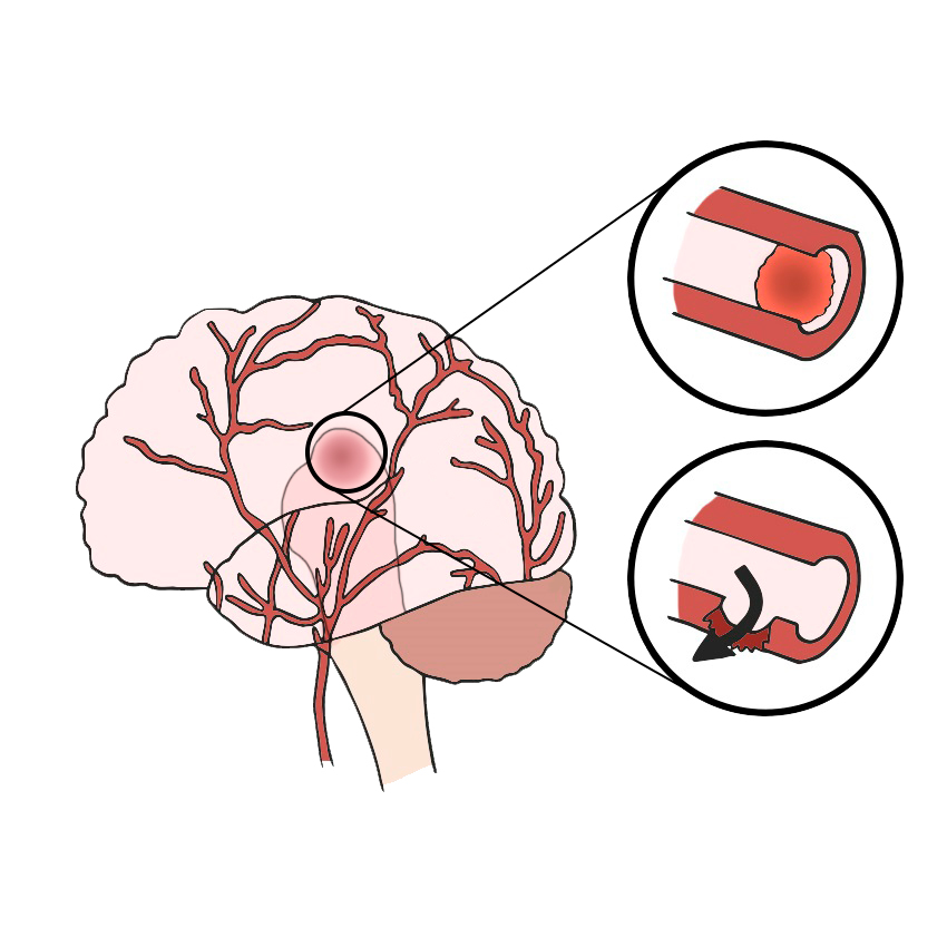 Mesencephalic stroke