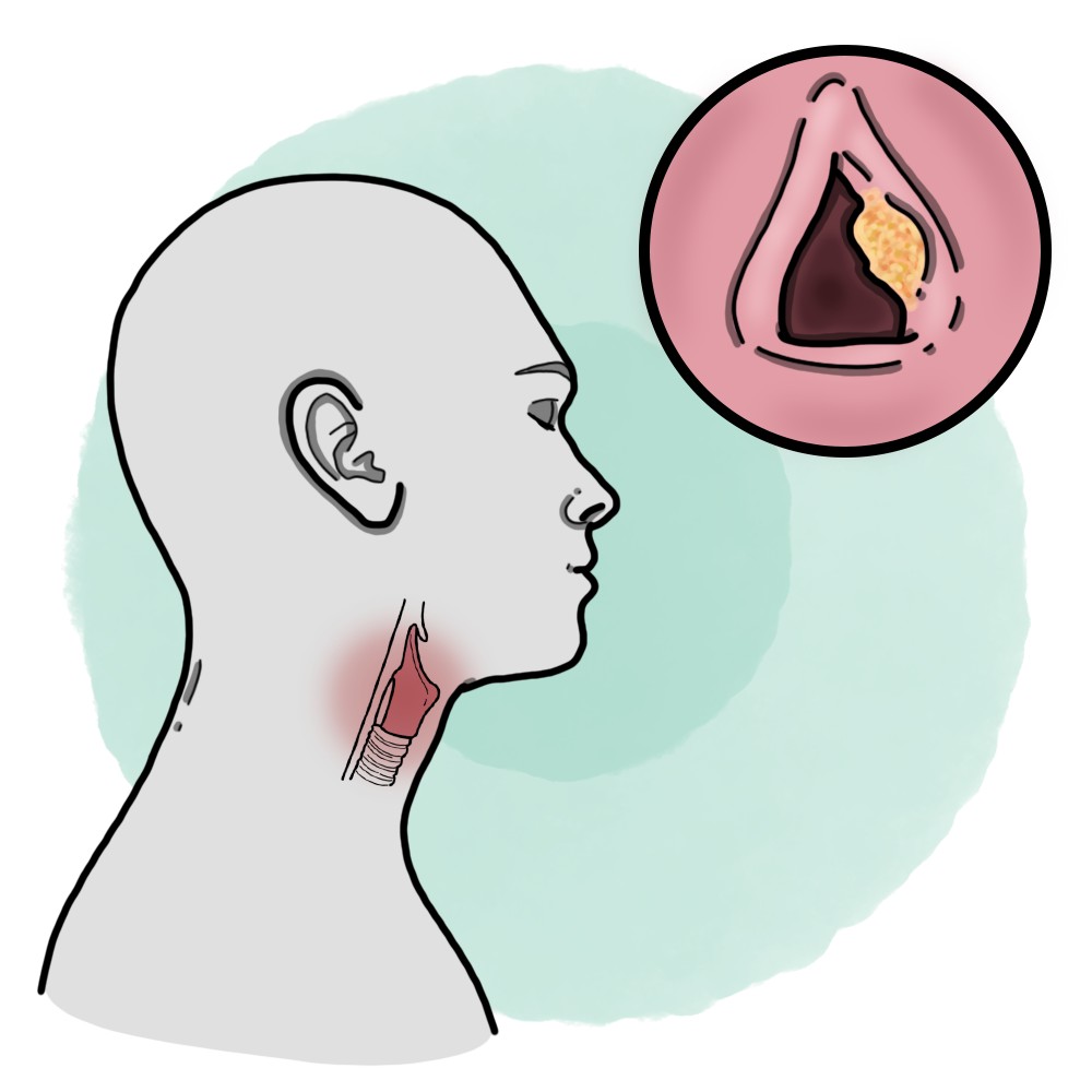 Laryngeal carcinoma