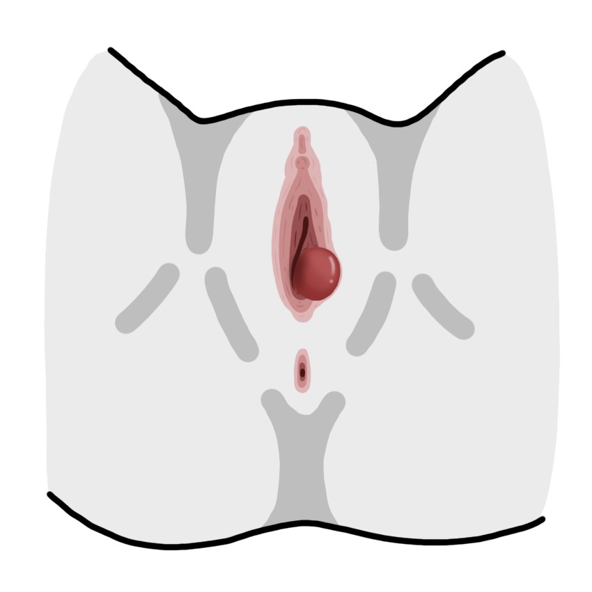 Lump in female genitals