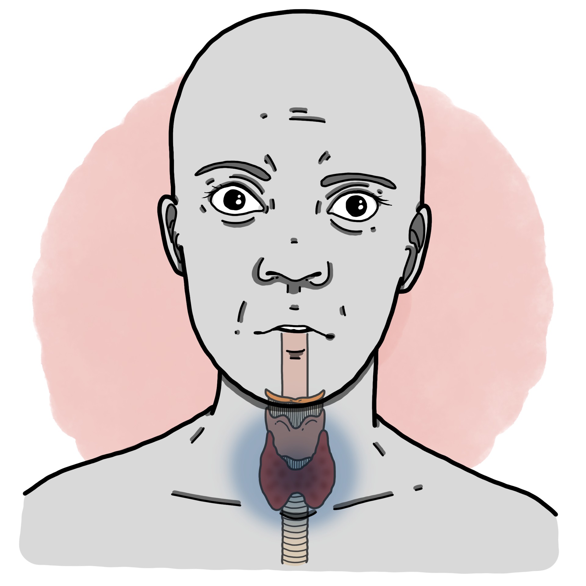 Thyroid storm - Thyrotoxic crisis