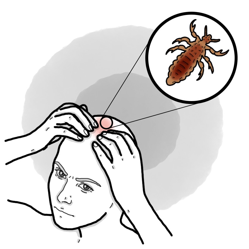 Lice - Pediculosis (Paediatrics)