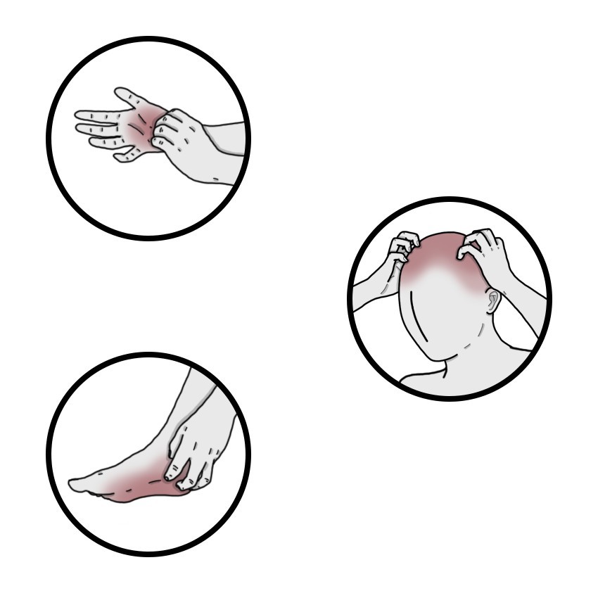 Hevige jeuk aan handpalmen, voetzolen en/of hoofdhuid