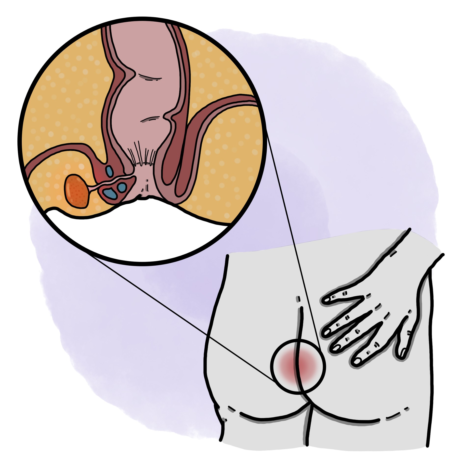 Abscess - Anal fistula