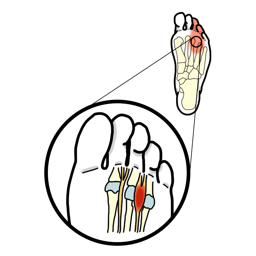 Anterior metatarsalgia - Morton's neuroma