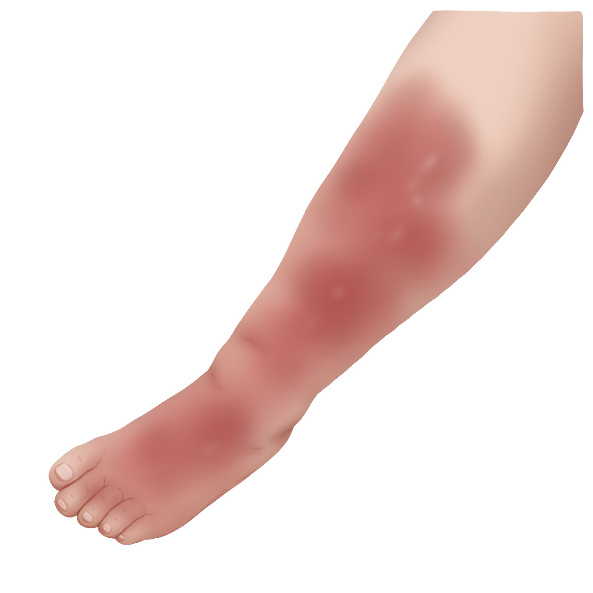 Cellulitis