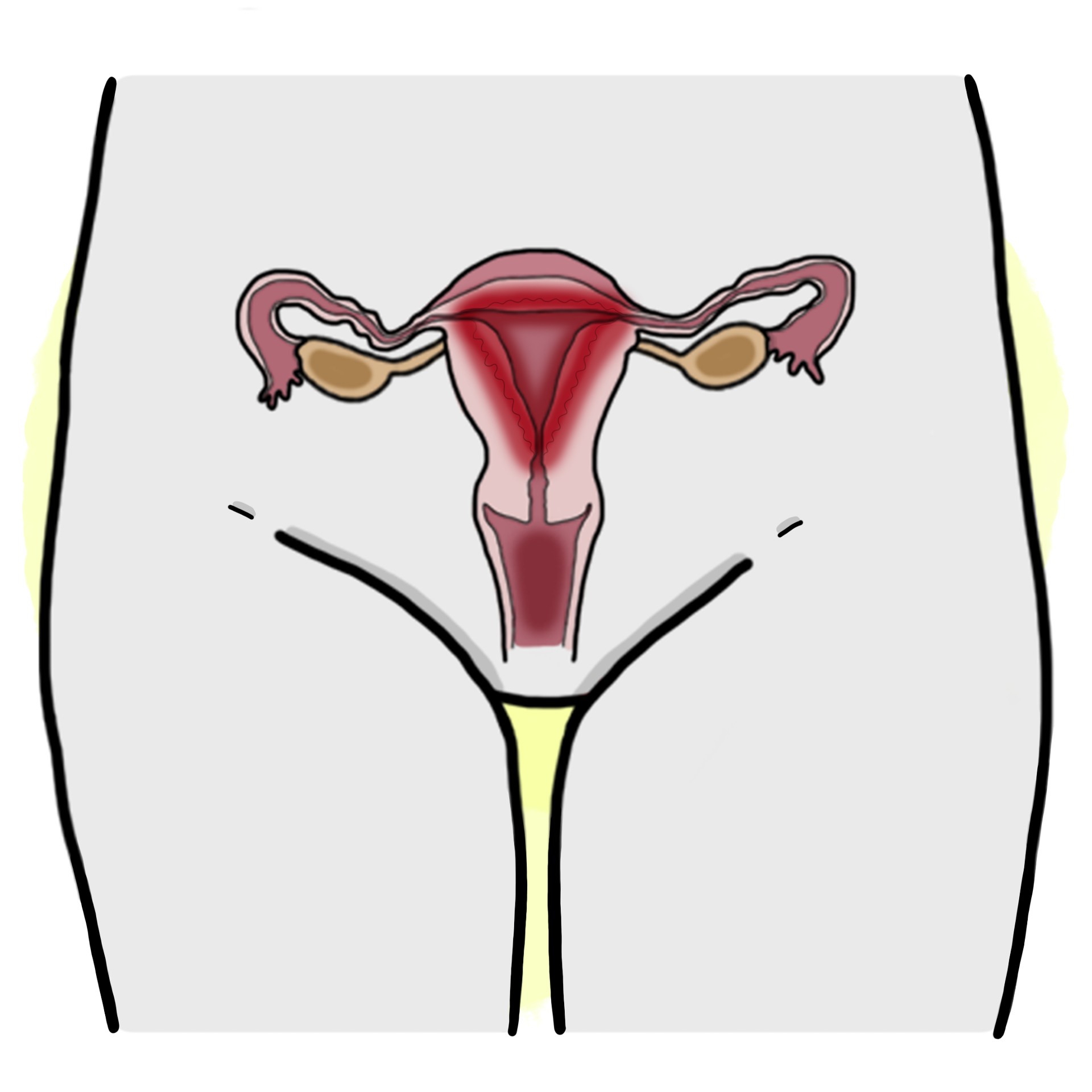 Puerperal endometritis