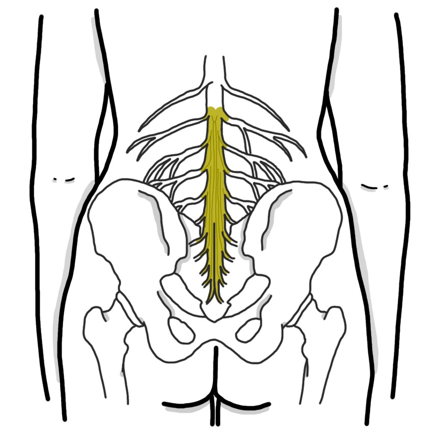 Cauda equina syndrome