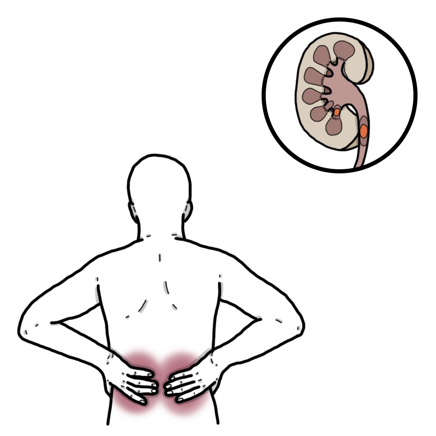 Obstructive uropathy - Urolithiasis
