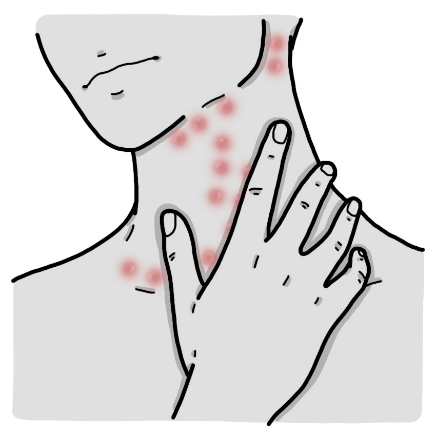 Ganglions au cou enflammés