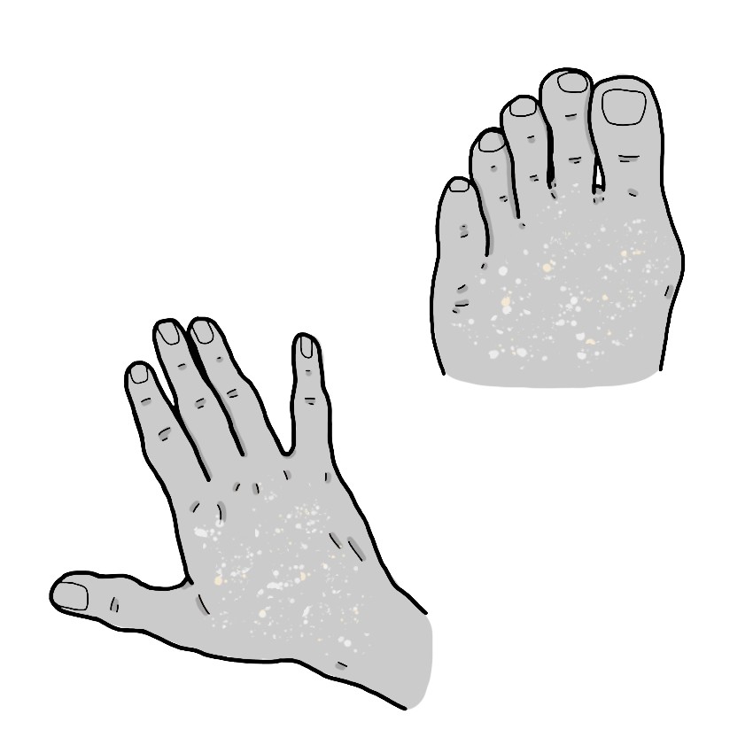 Desquamation of hands and/or feet