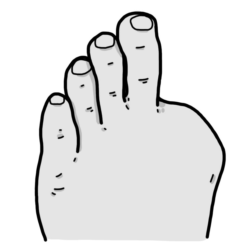 Recent left big toe amputation