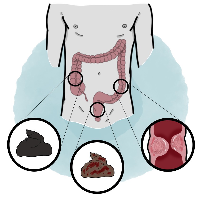 Colon cancer - Colorectal neoplasia