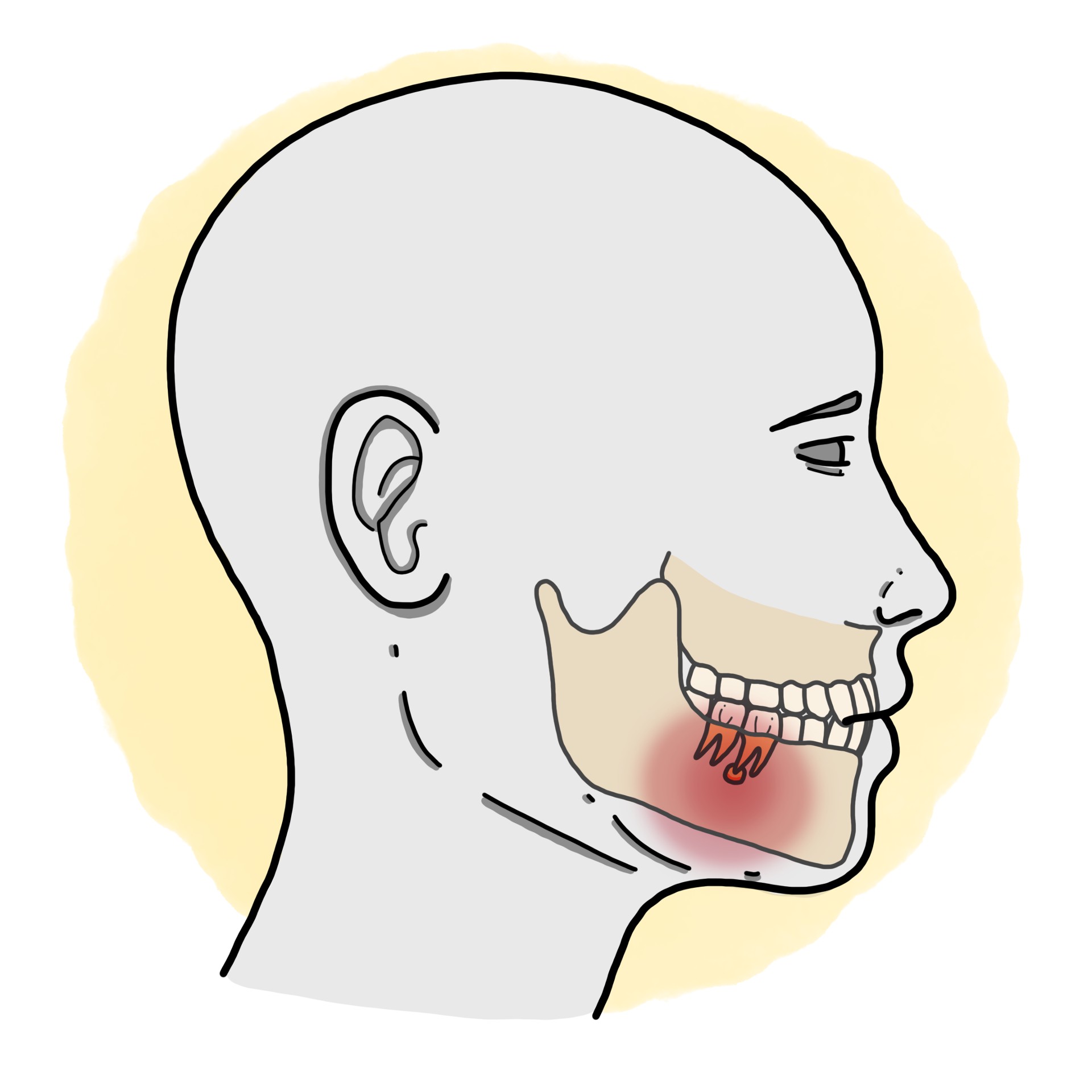 Dental abscess
