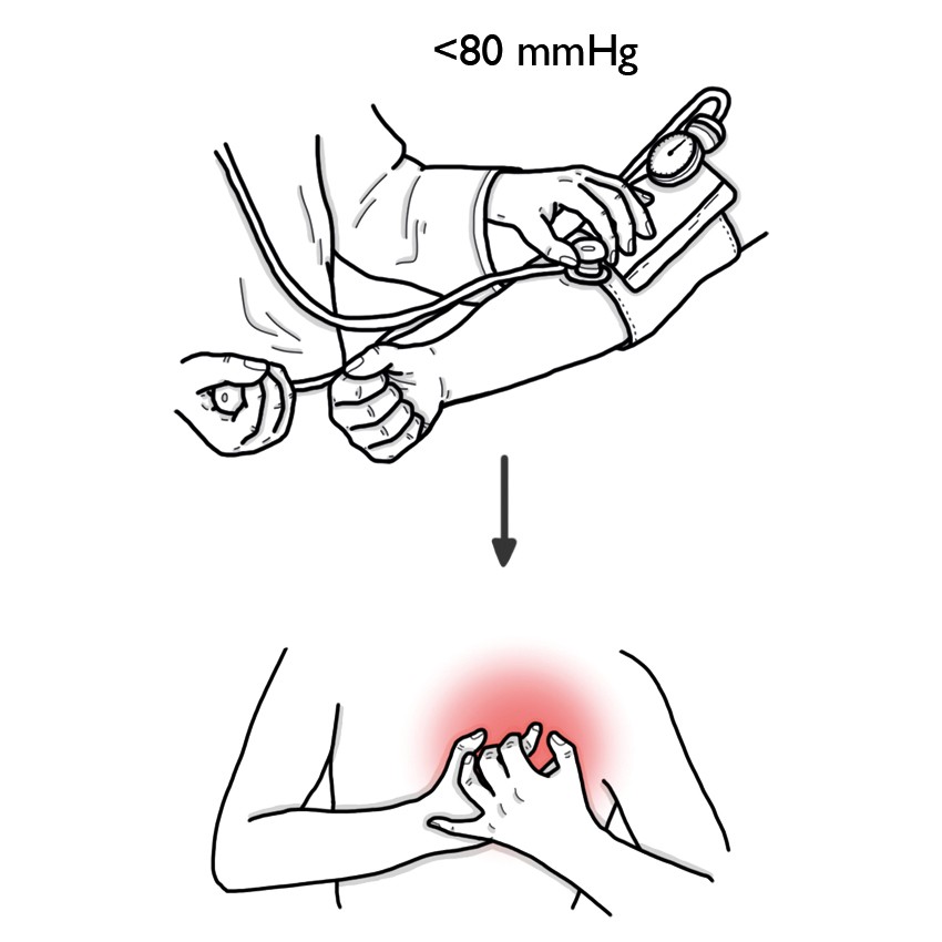 Severe hypotension / Shock