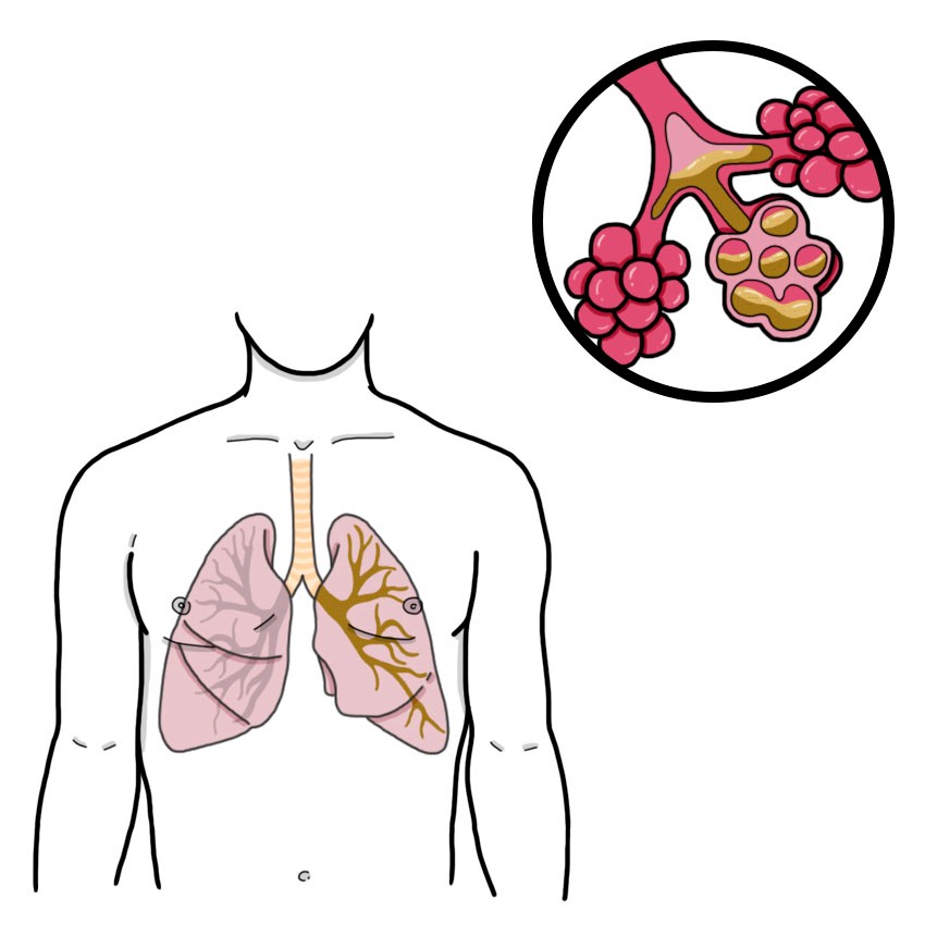 Cystic fibrosis (Paediatrics)
