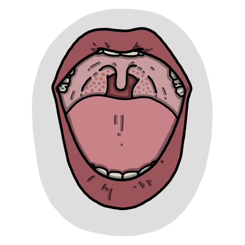 Rode en/of gezwollen amandelen