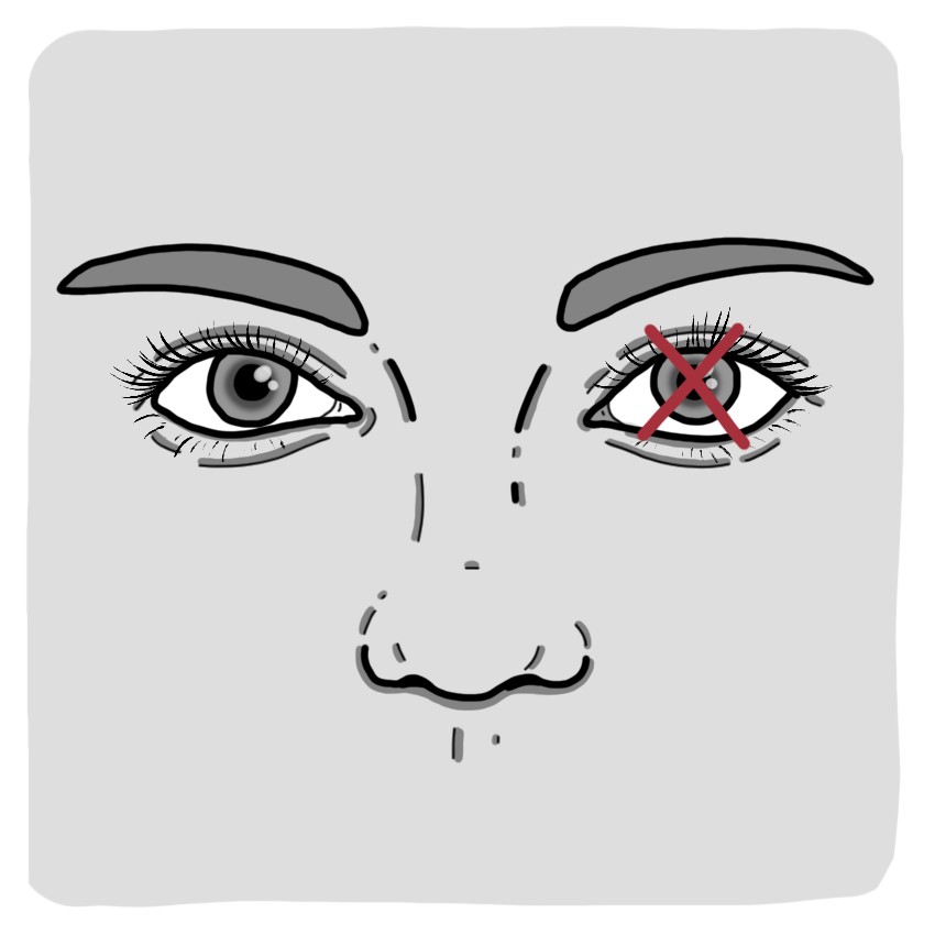 Perdita totale della vista in un occhio