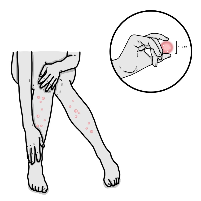 Painful nodules below the knees
