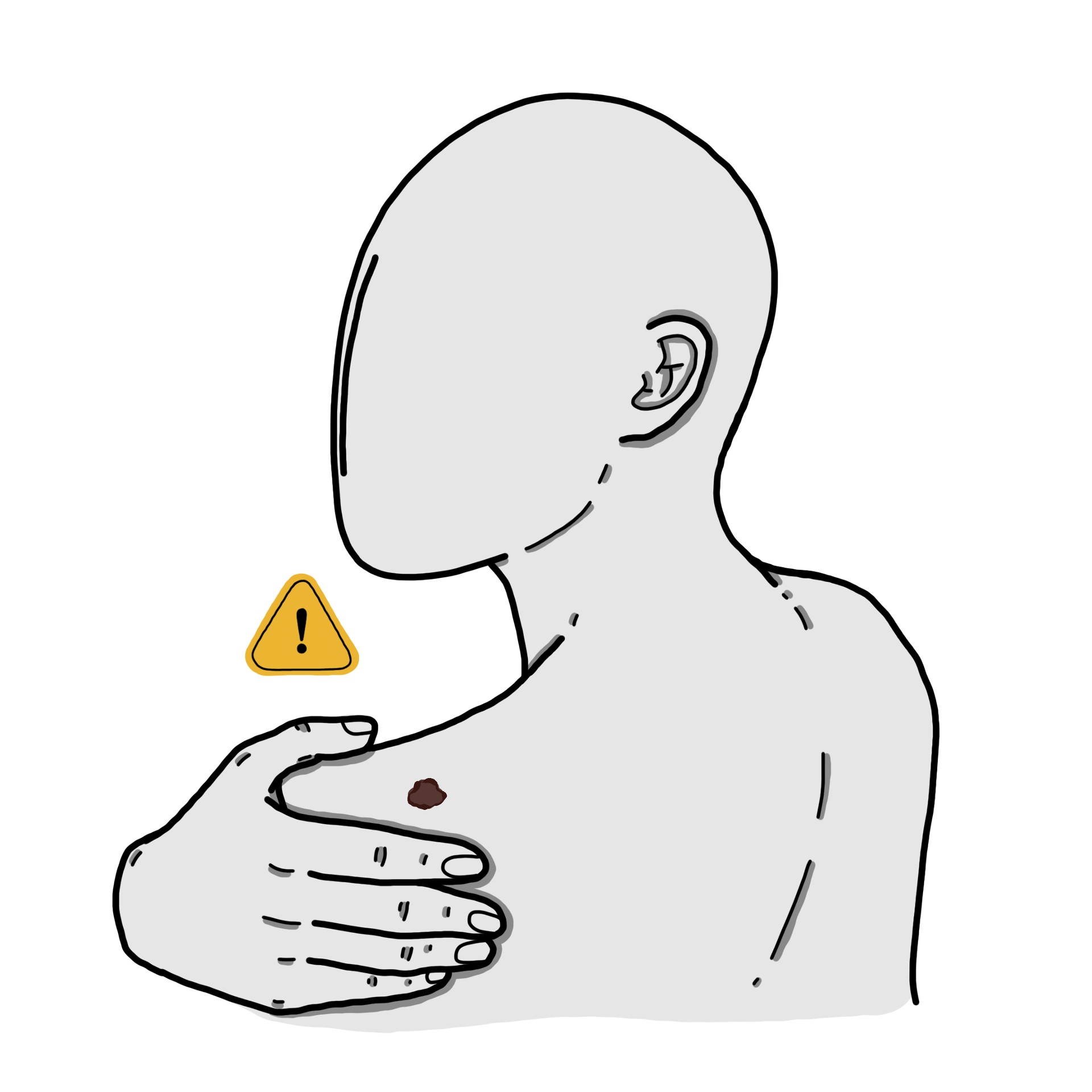 Nevus