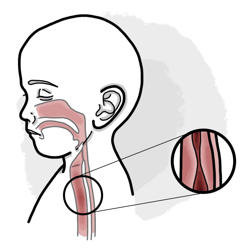 Acute laryngotracheitis - Croup (Paediatrics)