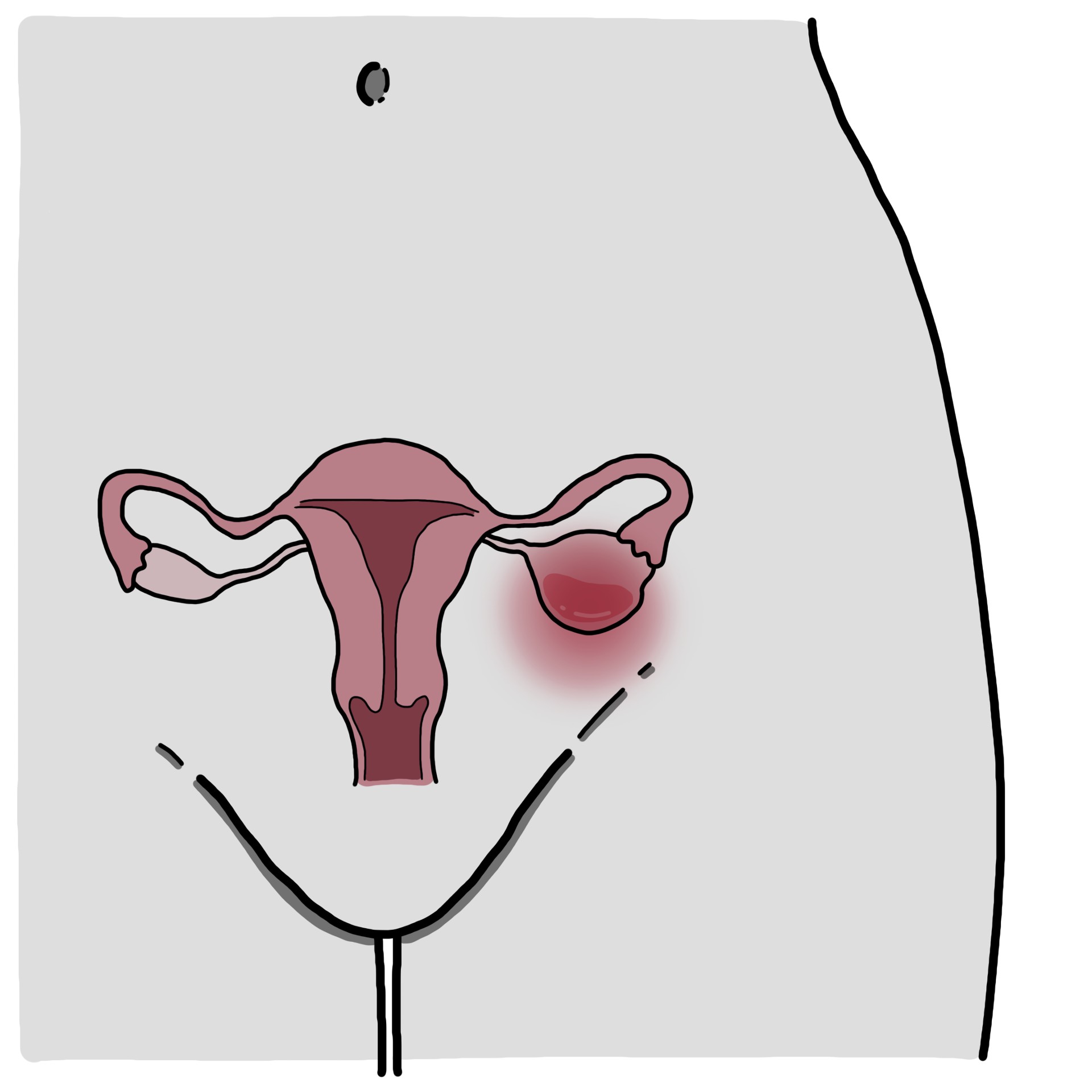 Ovarian cyst