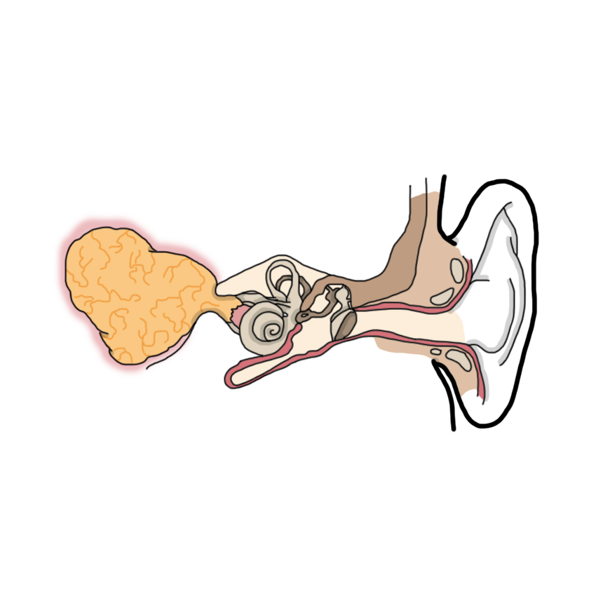 Vestibular schwannoma