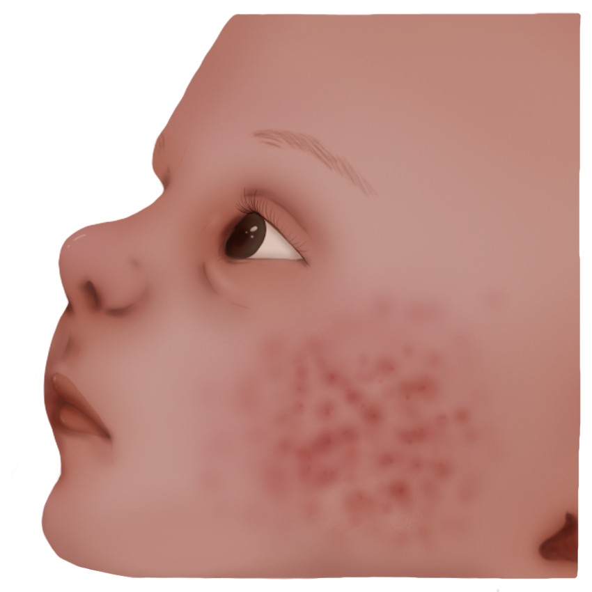 Toxic erythema of the newborn (Paediatrics)