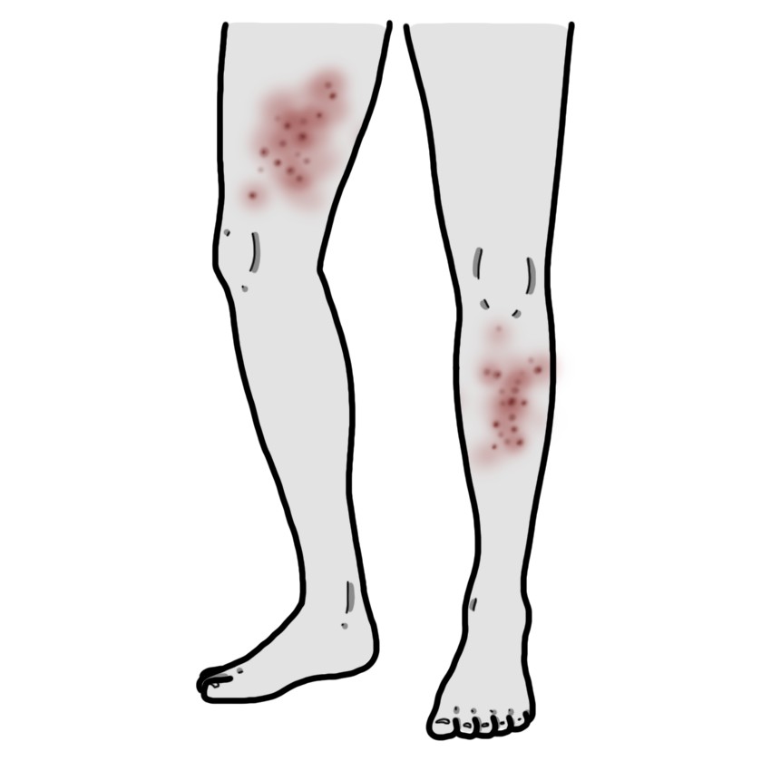 Hautausschlag am Bein / an den Beinen