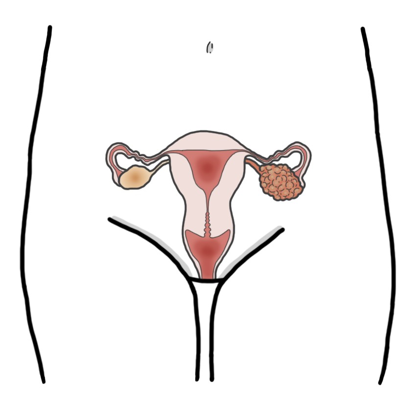 Polycystic ovary syndrome