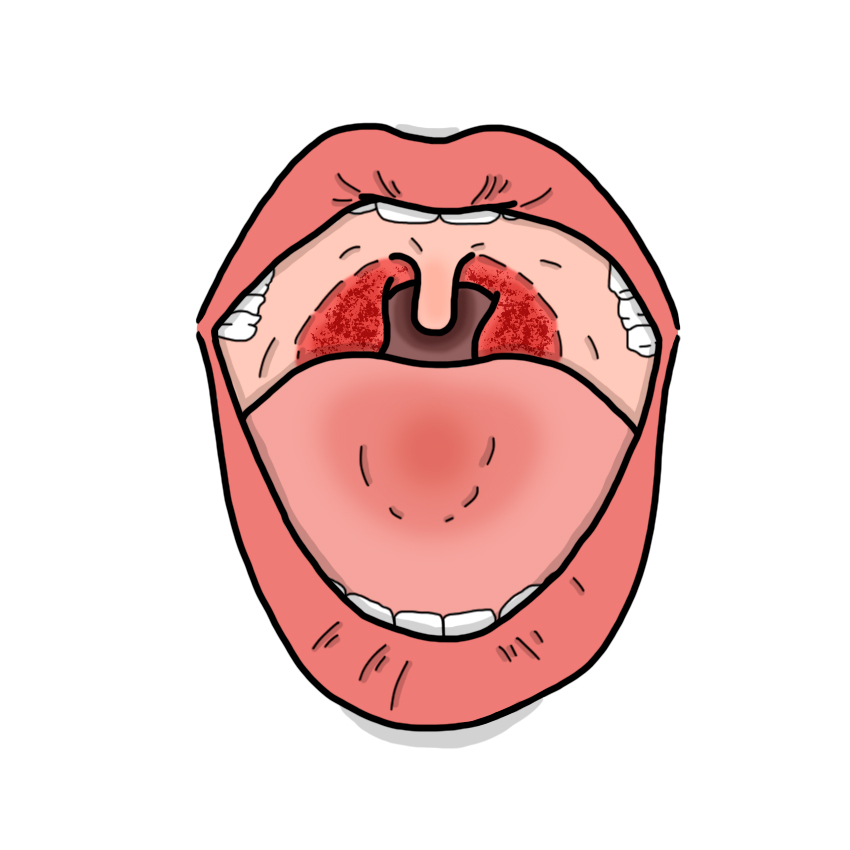 Palatal petechiae