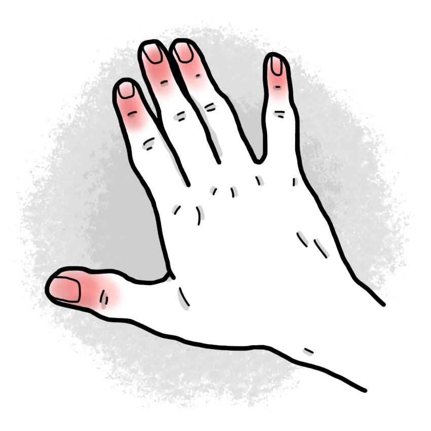 Superficial first degree frostbite - frostnip