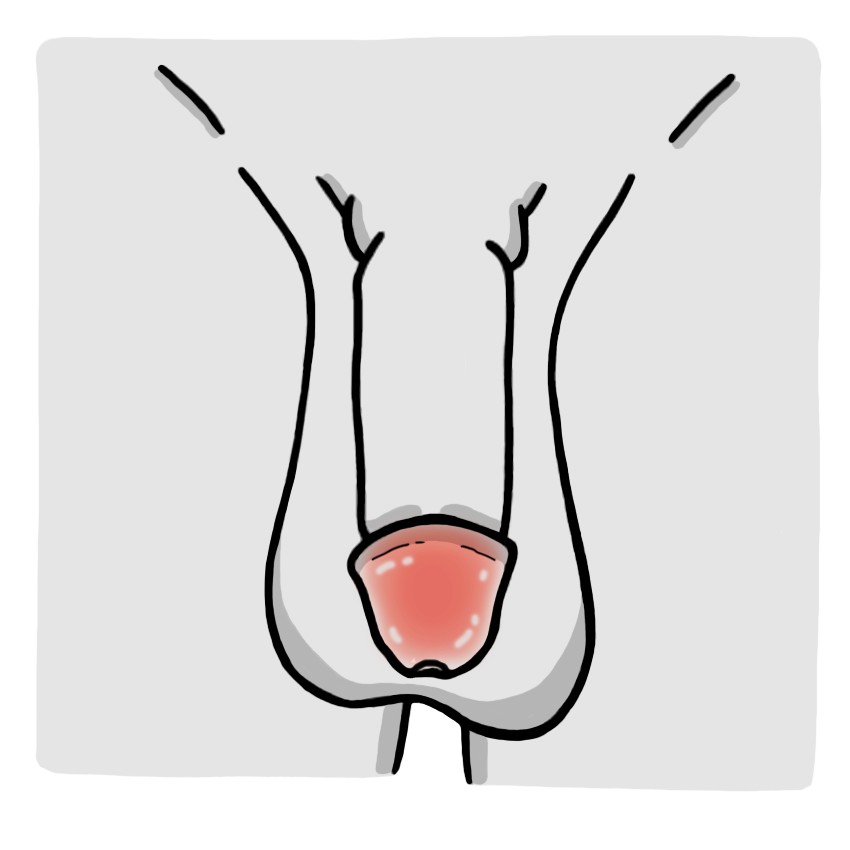 Inflamação da glande do pênis