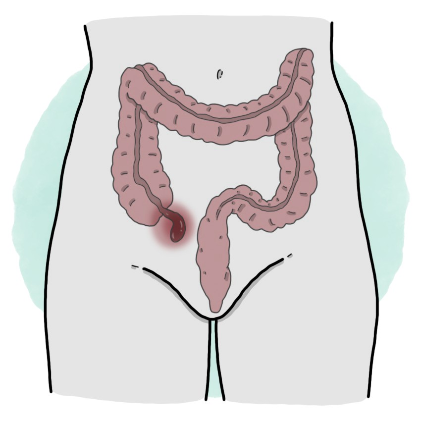 Appendicitis (Paediatrics)