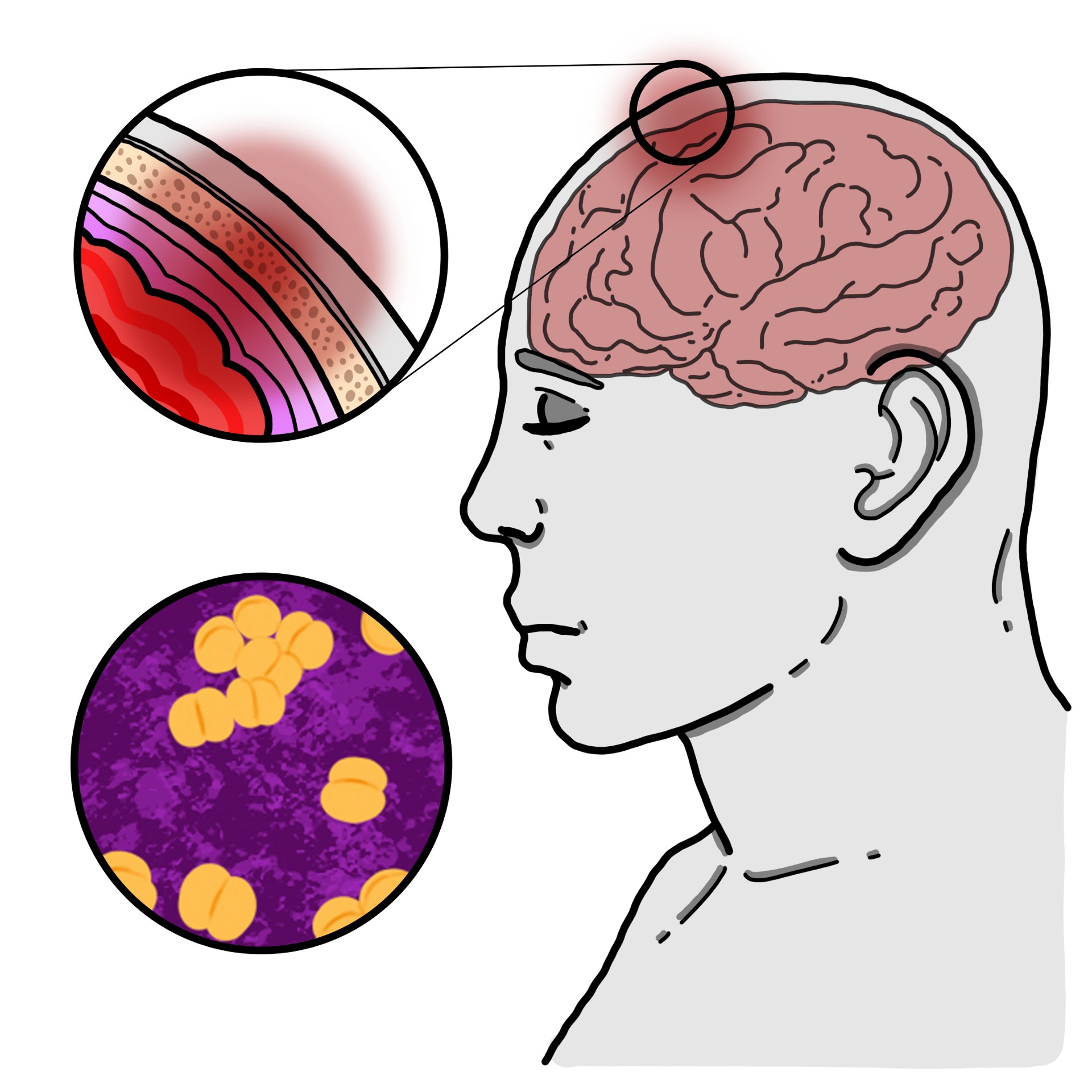 Bacterial meningitis