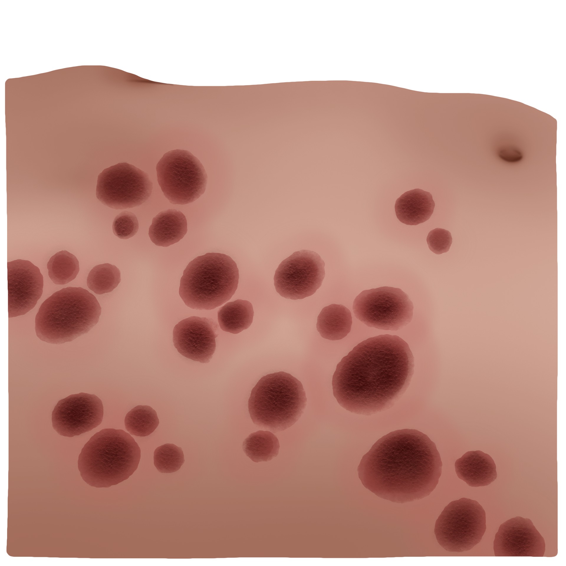 Stevens-Johnson syndrome