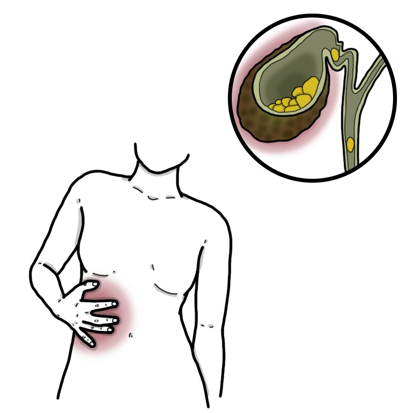 Inflammation of the gallbladder - Cholecystitis