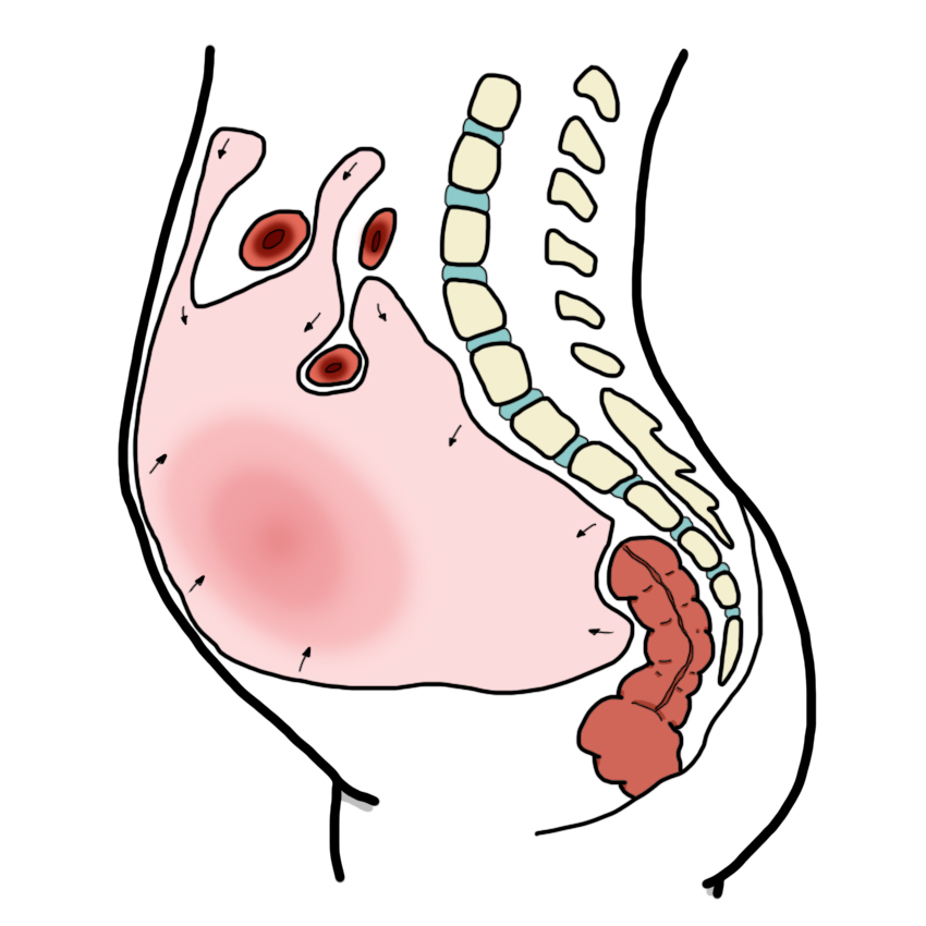 Spontaneous bacterial peritonitis