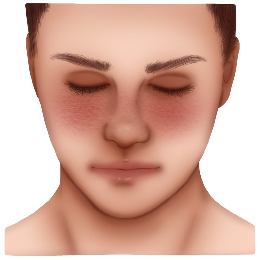 Systemic lupus erythematosus