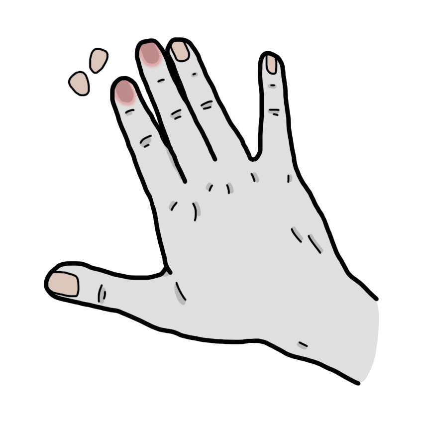 Nails detaching from the nail bed