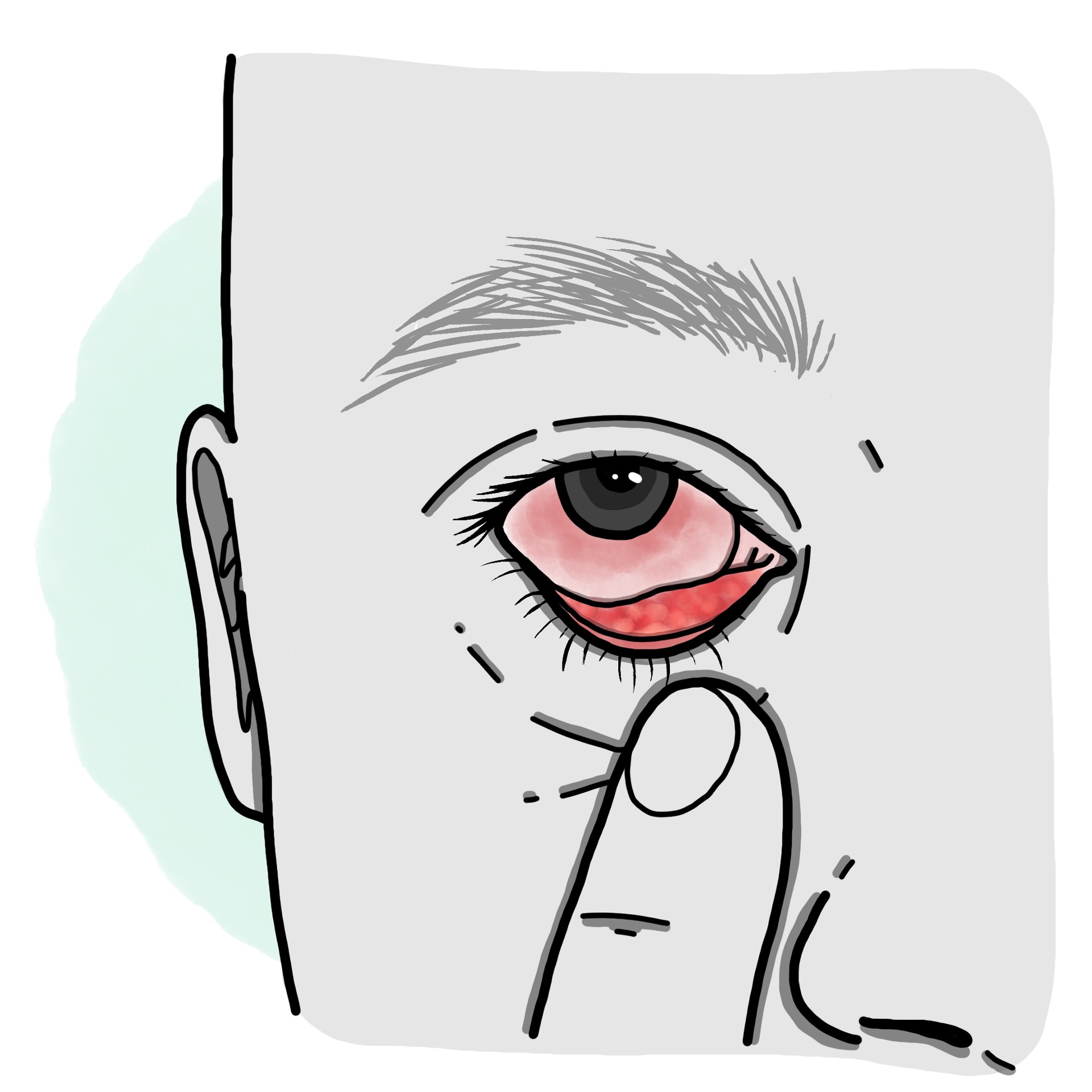 Conjunctivitis due to chlamydia trachomatis - Trachoma