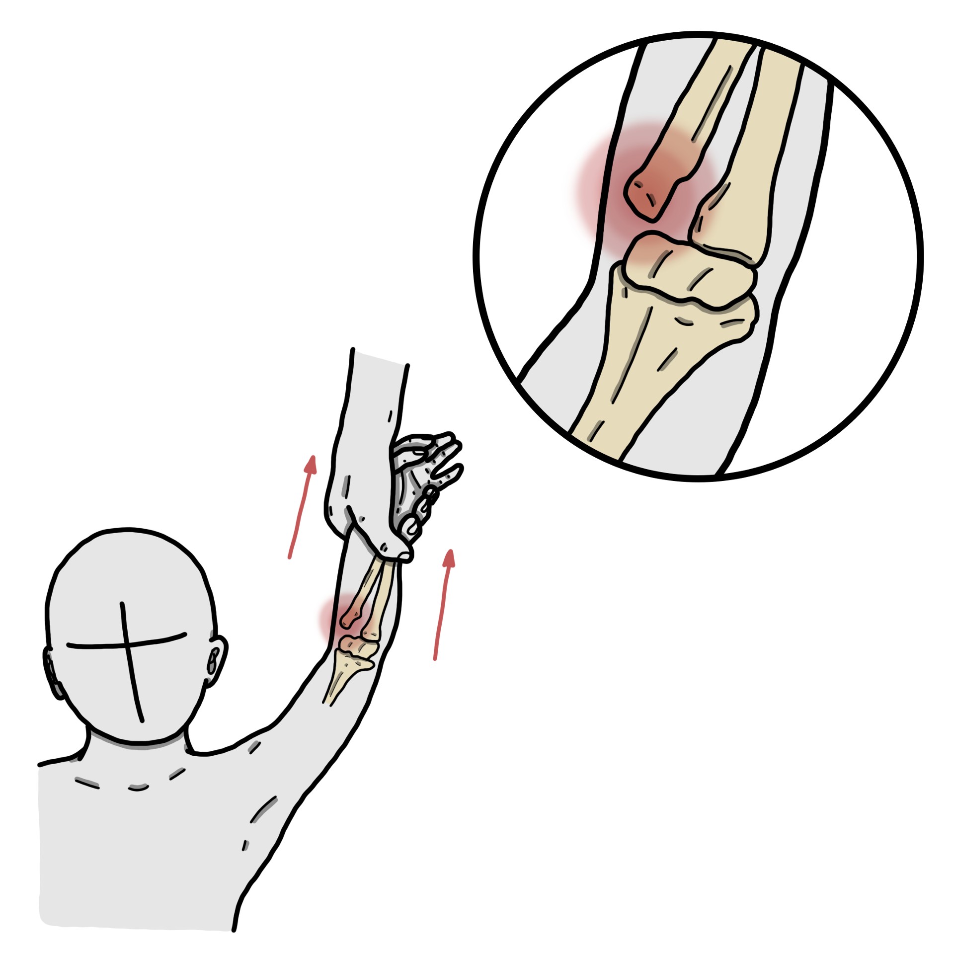 Painful pronation - Radial head subluxation (Paediatrics)
