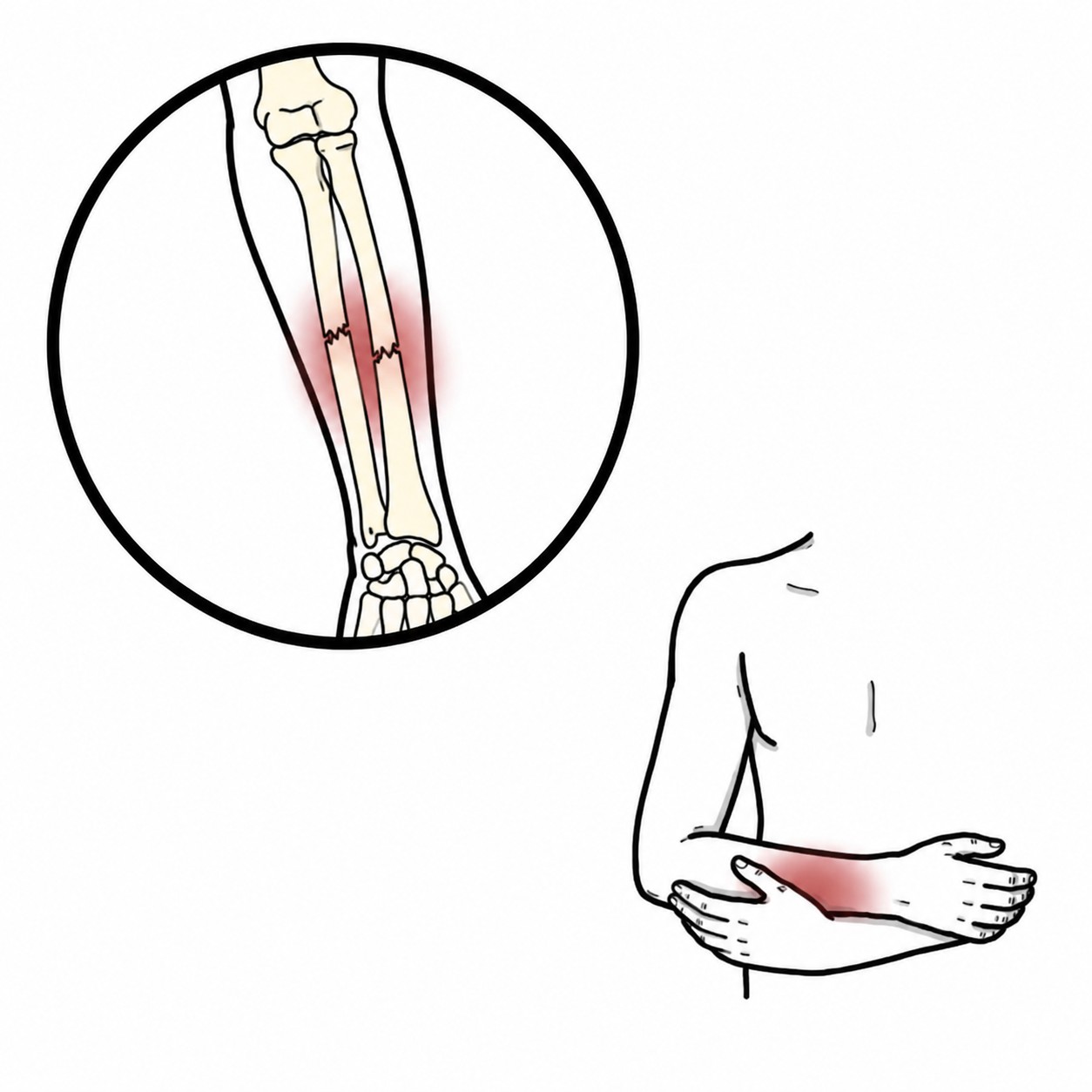 Fracture of the mid-forearm - Fracture of ulna and radius