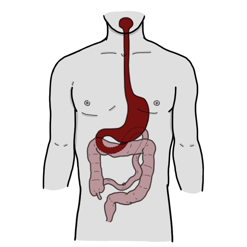 Upper gastrointestinal bleeding - Proximal to the Treitz ligament