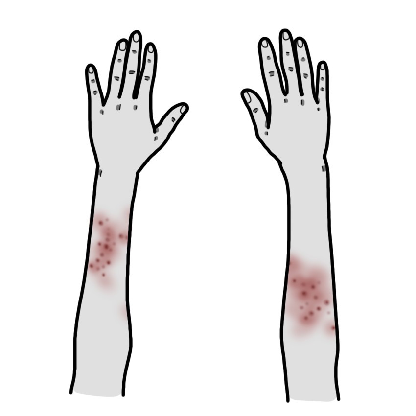 Rash on the arm/arms