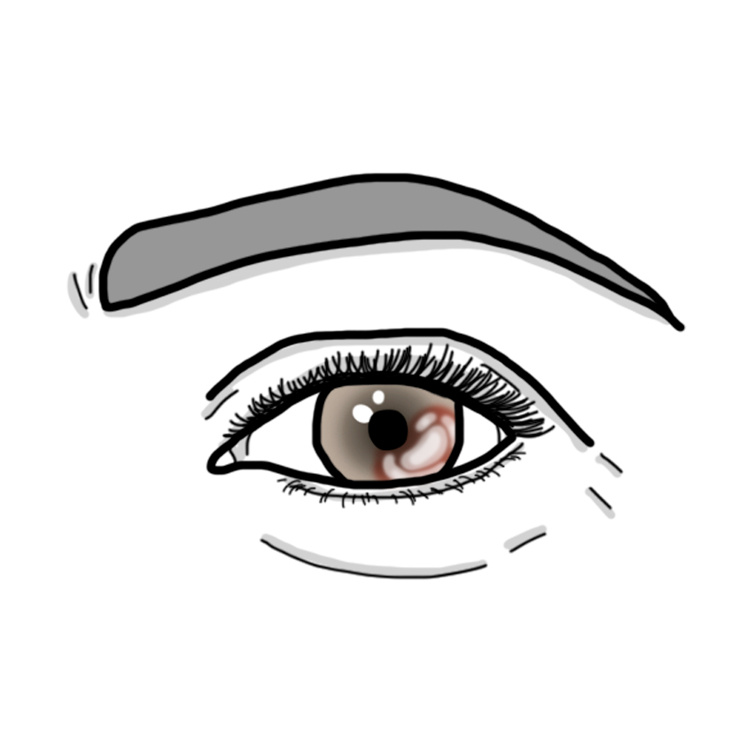 Hornhautentzündung - Keratitis