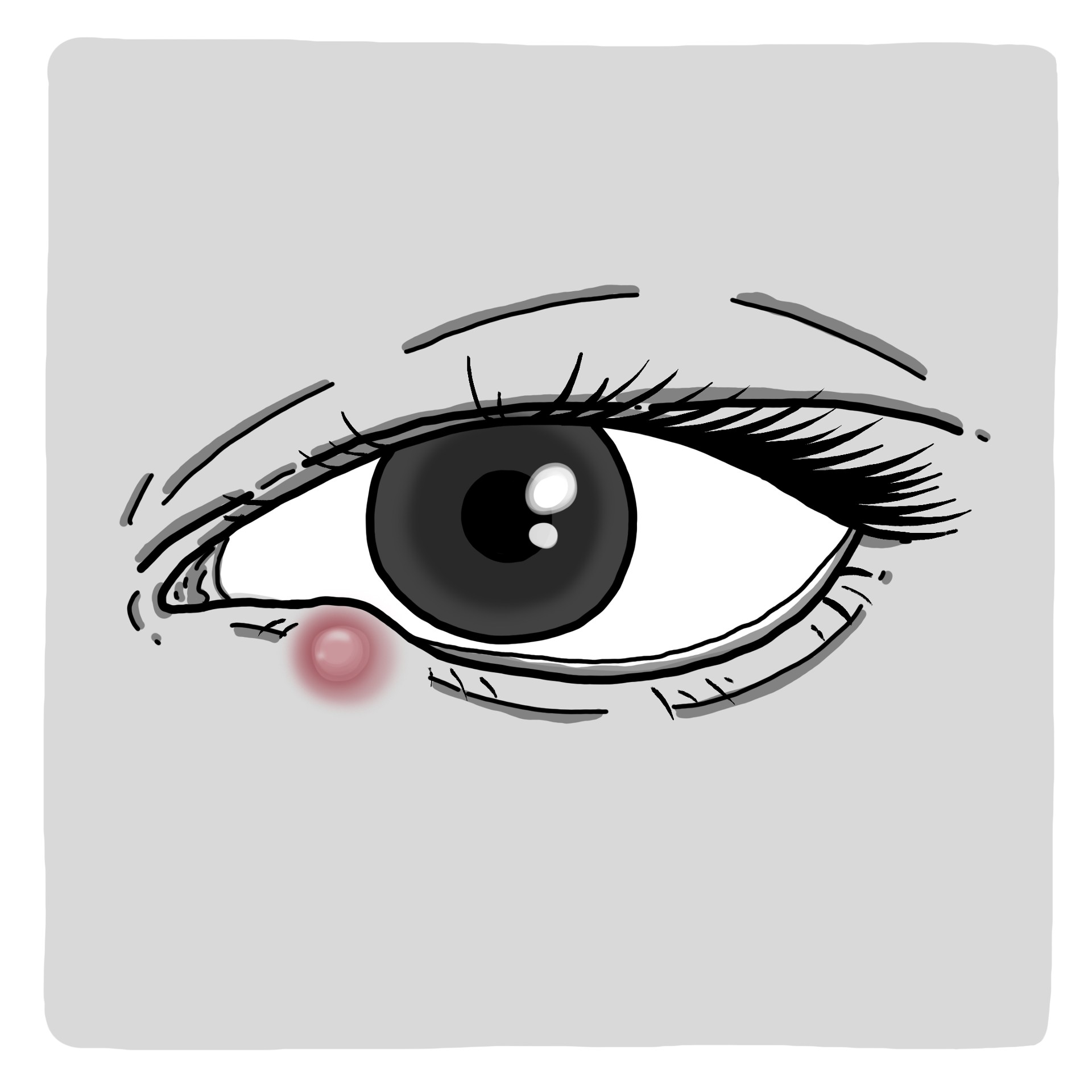 まぶたのしこり