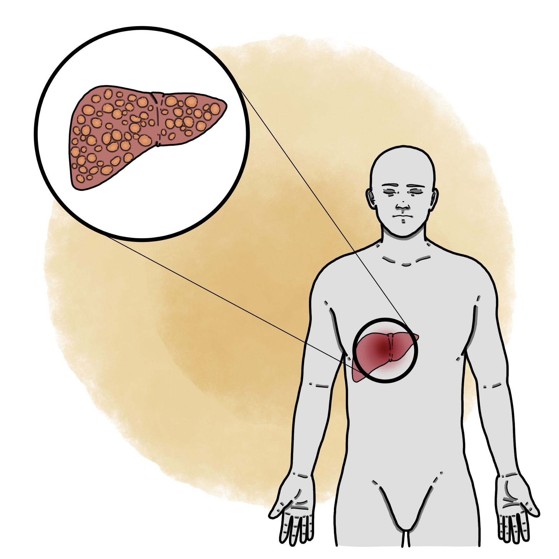 Liver cirrhosis