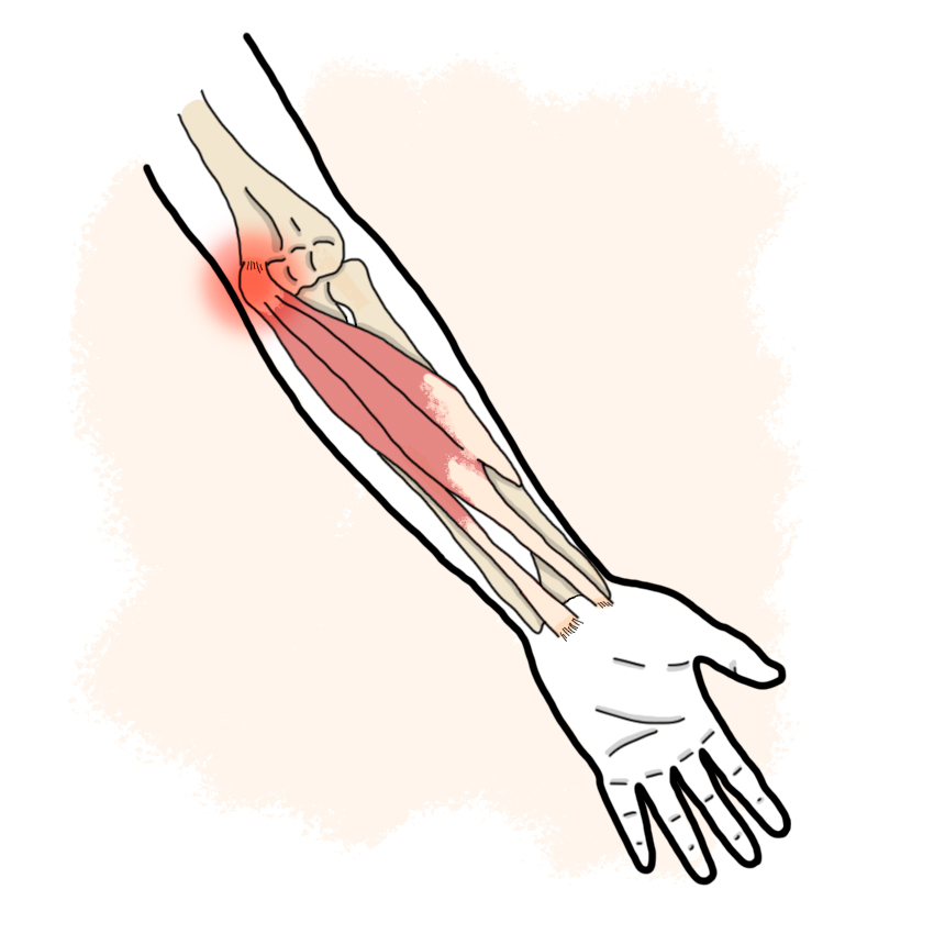 Medial epicondylitis - Golfer's elbow