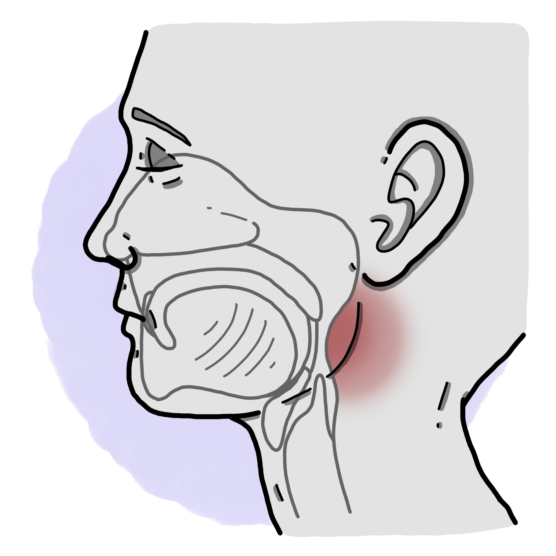 Retropharyngeal abscess